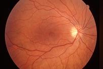 Alterazioni vascolari oculari e cutanee nell'aterosclerosi